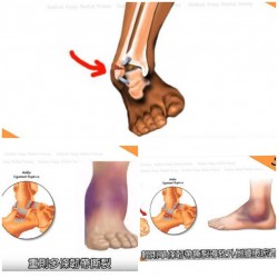 足踝/足部 部位常見問題